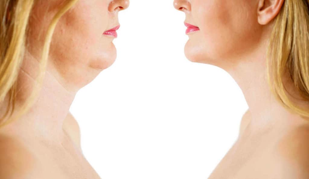Double Chin treatment Hampstead Heath before and after results