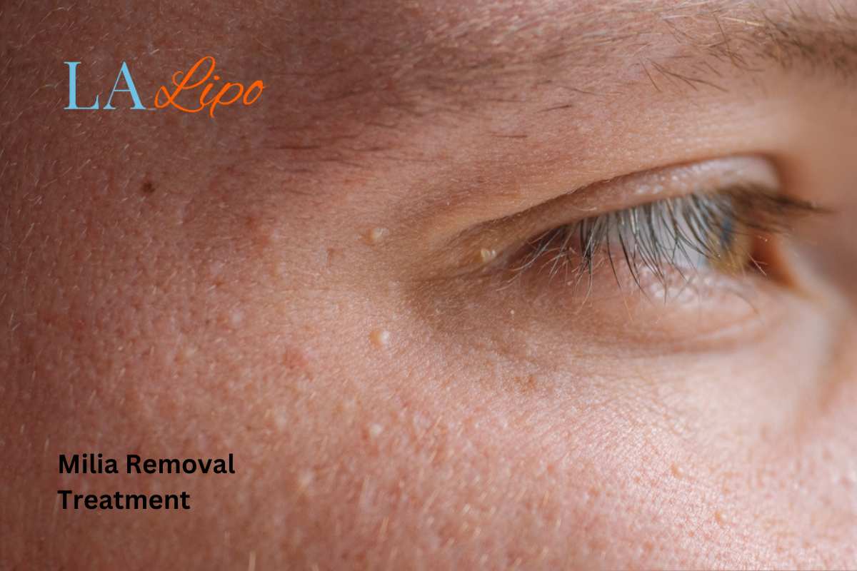 Cryopen Milia Removal: Is It the Easiest and Safest Option Hampstead Heath?