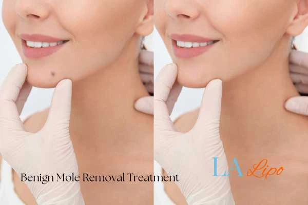 Before and after mole removal Hampstead Heath treatment