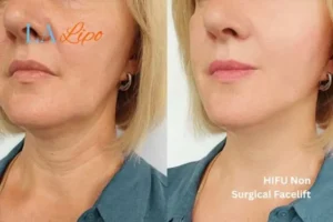 hi-fu for wrinkles Hampstead Heath before and after results
