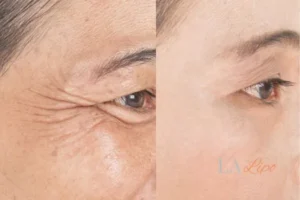 Before and after results of woman - HI-fu wrinkles reduction treatment Hampstead Heath