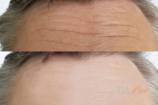 results of HIFU Hampstead Heath on mans forehead to help reduce lines and wrinkles