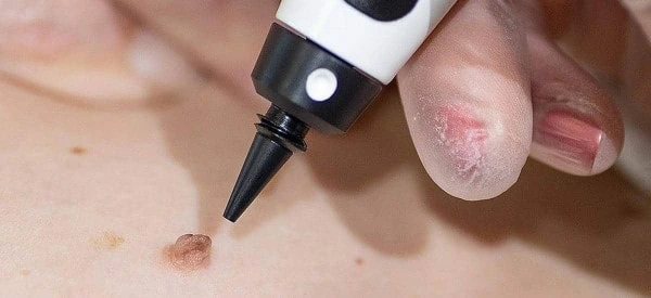 skin tag removal using cryopen Hampstead Heath