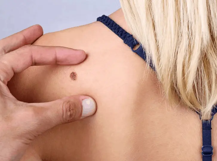 woman having mole removal Hampstead Heath consultation before treatment.