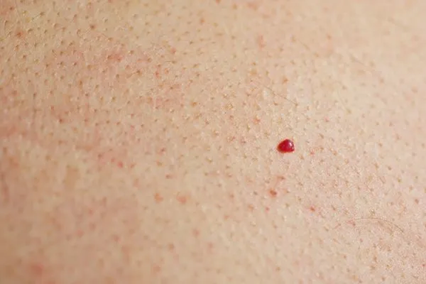 close up of a cherry angioma Hampstead Heath