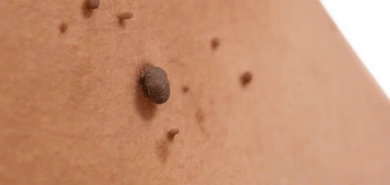 image of a skin tag Hampstead Heath
