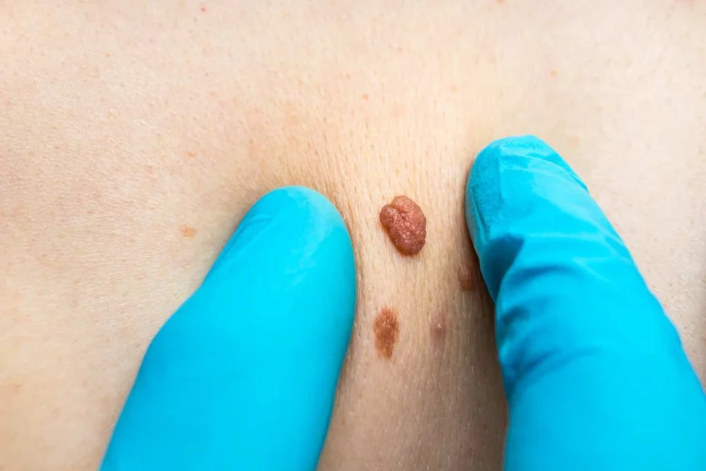 Consultant examining a skin tag Hampstead Heath