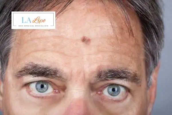 Solar Lentigo Removal Hampstead Heath image of man with mark on his forehead