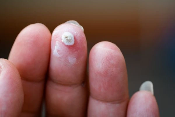 wart on person finger - cryotherapy to treat from LA LIPO Hampstead Heath