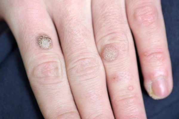 photo of warts on person hand - see wart removal Hampstead Heath from LA LIPO
