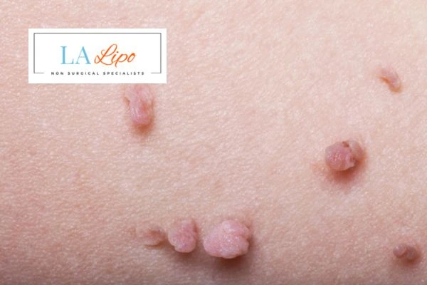 Does cryopen skin tag removal Hampstead Heath hurt? Find out now call our team today!