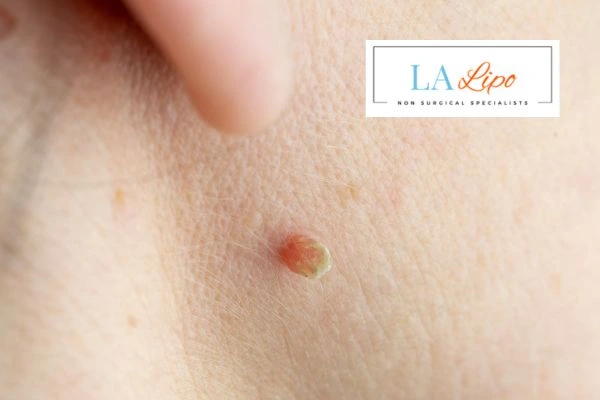Book skin tag removal Hampstead Heath today speak to our team now!