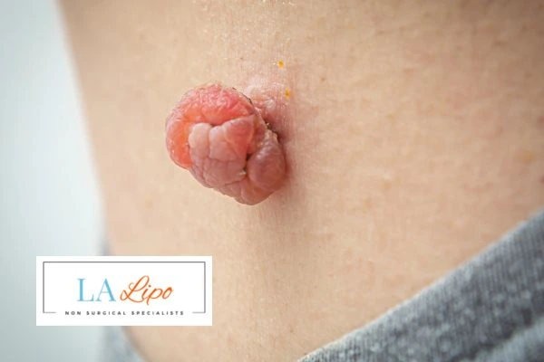 Interested in skin tag removal Hampstead Heath? Concerned about the pain? Find out more today!