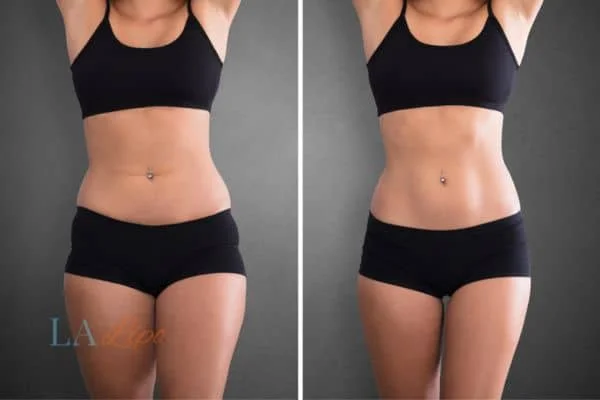 before and after results of non-surgical treatment to help a woman's body image and mental health Hampstead Heath