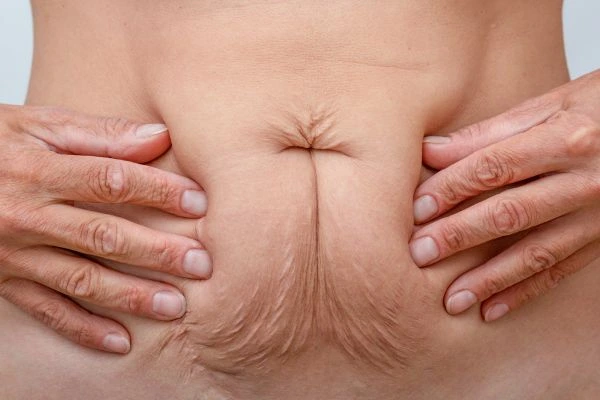 Image of a woman's stomach with loose skin - example of skin tightening Hampstead Heath options
